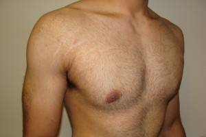 Gynecomastia Before and After 12 | Grover Aesthetics