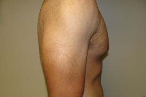 Gynecomastia Before and After 12 | Grover Aesthetics
