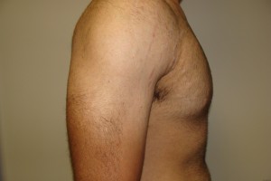 Gynecomastia Before and After 12 | Grover Aesthetics