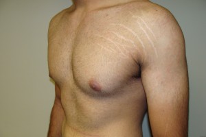 Gynecomastia Before and After 12 | Grover Aesthetics