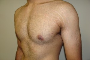 Gynecomastia Before and After 12 | Grover Aesthetics