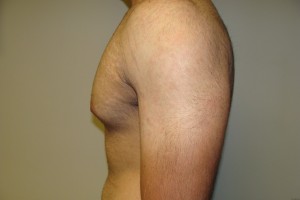 Gynecomastia Before and After 12 | Grover Aesthetics