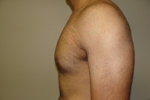 Gynecomastia Before and After 12 | Grover Aesthetics