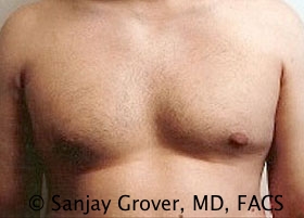 Gynecomastia Before and After | Grover Aesthetics