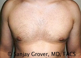 Gynecomastia Before and After 13 | Sanjay Grover MD FACS
