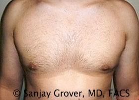 Gynecomastia Before and After | Grover Aesthetics