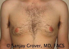 Gynecomastia Before and After 14 | Sanjay Grover MD FACS