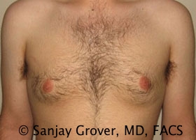 Gynecomastia Before and After | Grover Aesthetics