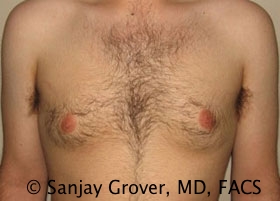 Gynecomastia Before and After | Sanjay Grover MD FACS