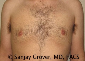 Gynecomastia Before and After | Grover Aesthetics
