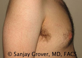 Gynecomastia Before and After 14 | Grover Aesthetics