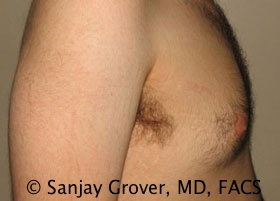 Gynecomastia Before and After 14 | Sanjay Grover MD FACS