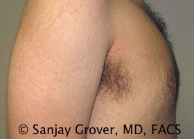 Gynecomastia Before and After 14 | Sanjay Grover MD FACS