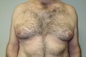 Gynecomastia Before and After | Grover Aesthetics