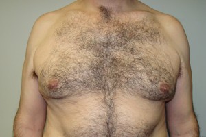 Gynecomastia Before and After | Grover Aesthetics