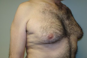 Gynecomastia Before and After 15 | Grover Aesthetics