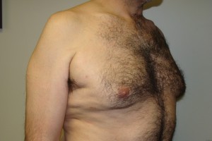 Gynecomastia Before and After 15 | Grover Aesthetics