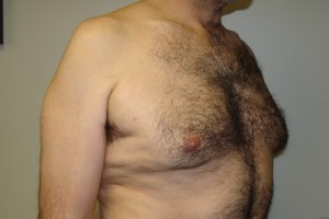 Gynecomastia Before and After 15 | Sanjay Grover MD FACS