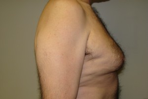 Gynecomastia Before and After 15 | Grover Aesthetics