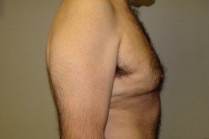Gynecomastia Before and After 15 | Grover Aesthetics