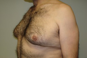 Gynecomastia Before and After 15 | Sanjay Grover MD FACS