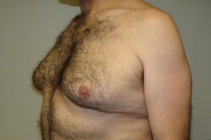 Gynecomastia Before and After 15 | Grover Aesthetics