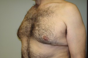 Gynecomastia Before and After 15 | Grover Aesthetics