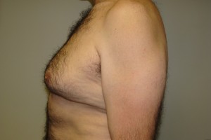 Gynecomastia Before and After 15 | Grover Aesthetics