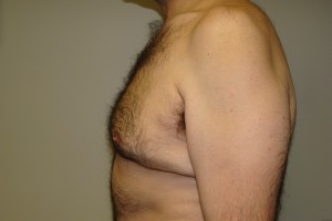Gynecomastia Before and After 15 | Grover Aesthetics
