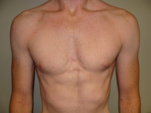 Gynecomastia Before and After | Grover Aesthetics