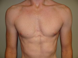 Gynecomastia Before and After 12 | Sanjay Grover MD FACS