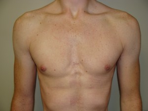 Gynecomastia Before and After | Grover Aesthetics