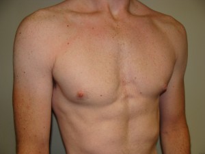 Gynecomastia Before and After 16 | Grover Aesthetics