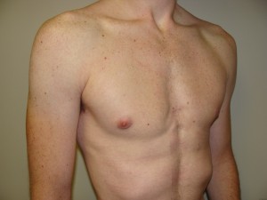 Gynecomastia Before and After 16 | Grover Aesthetics
