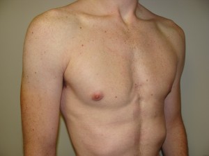 Gynecomastia Before and After 16 | Sanjay Grover MD FACS