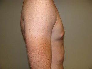 Gynecomastia Before and After 16 | Grover Aesthetics