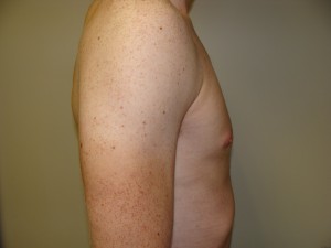Gynecomastia Before and After 16 | Grover Aesthetics