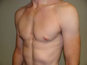 Gynecomastia Before and After 16 | Grover Aesthetics