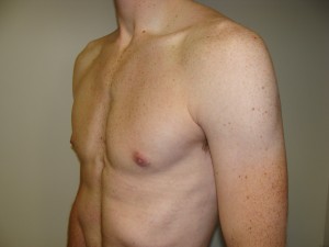 Gynecomastia Before and After 16 | Sanjay Grover MD FACS