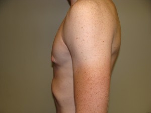 Gynecomastia Before and After 16 | Grover Aesthetics