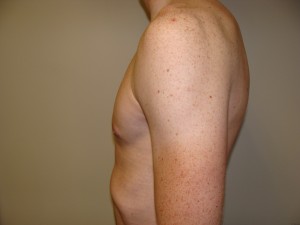Gynecomastia Before and After 16 | Grover Aesthetics