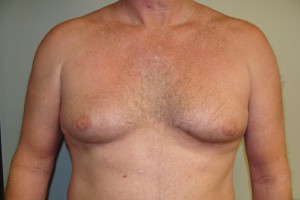 Gynecomastia Before and After | Grover Aesthetics