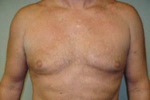 Gynecomastia Before and After | Grover Aesthetics