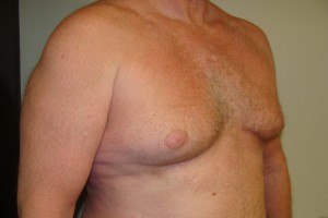 Gynecomastia Before and After 17 | Grover Aesthetics
