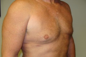 Gynecomastia Before and After 17 | Grover Aesthetics