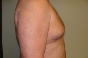 Gynecomastia Before and After 17 | Grover Aesthetics