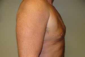 Gynecomastia Before and After 17 | Grover Aesthetics
