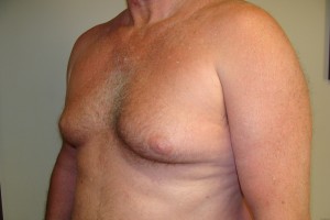 Gynecomastia Before and After 17 | Grover Aesthetics