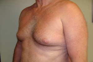 Gynecomastia Before and After 17 | Sanjay Grover MD FACS