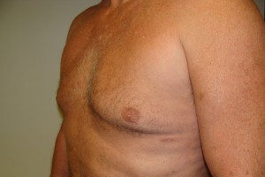 Gynecomastia Before and After 17 | Grover Aesthetics